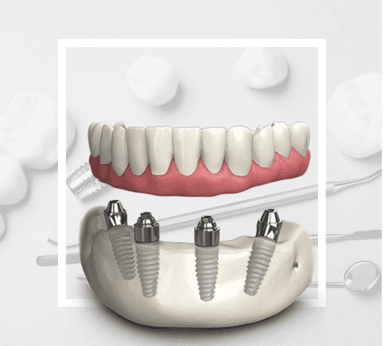 All on 4 İmplantlar