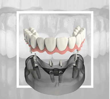 All on 6 İmplantlar