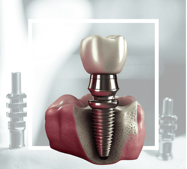 Diş İmplantları (Diş implantlarının avantajları, kullanım alanları, süreç)